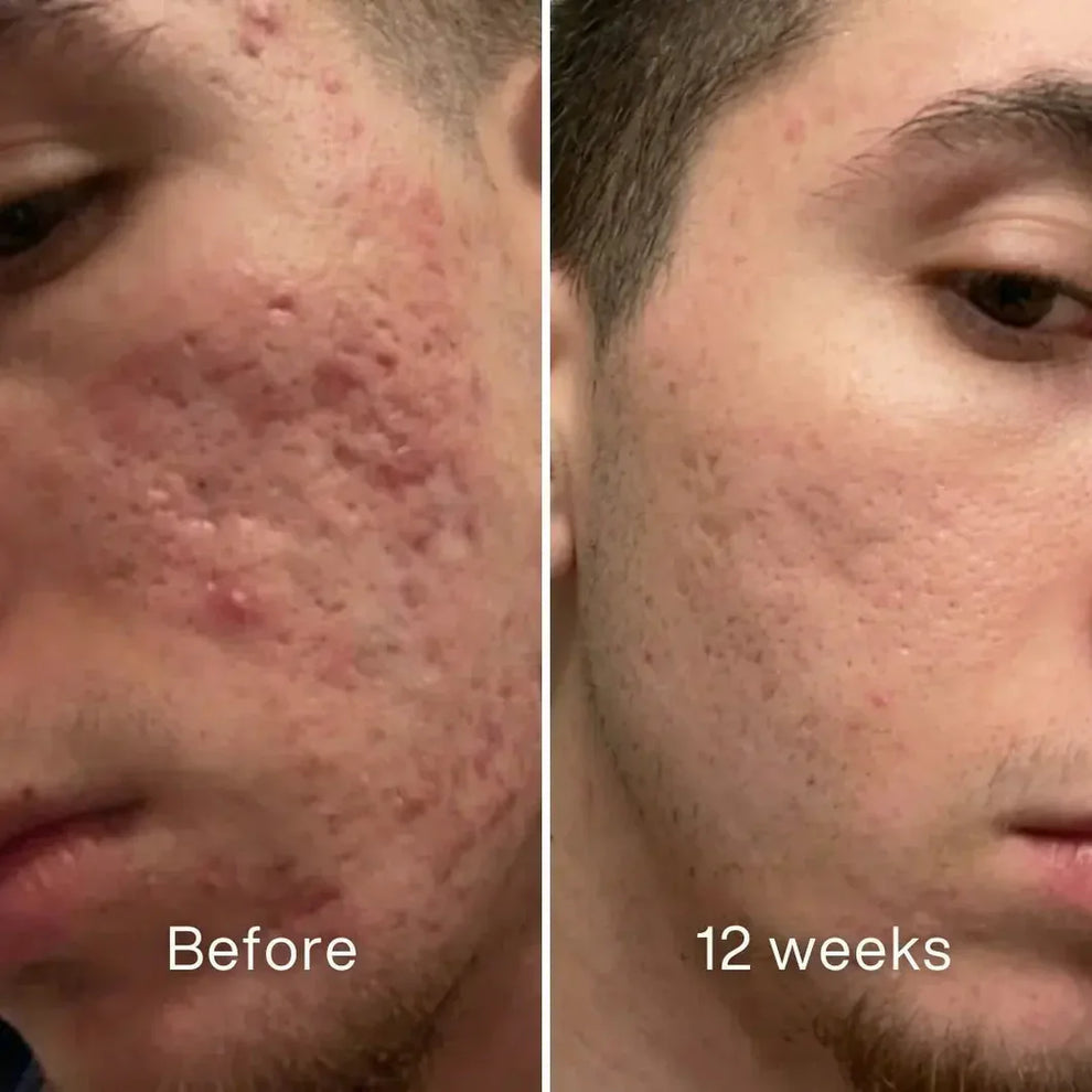 Stravax™ Clinical Acne Scar Repair Stick