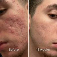 Stravax™ Clinical Acne Scar Repair Stick