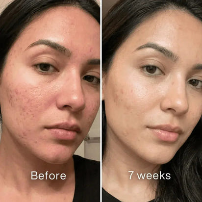 Stravax™ Clinical Acne Scar Repair Stick