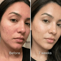 Stravax™ Clinical Acne Scar Repair Stick